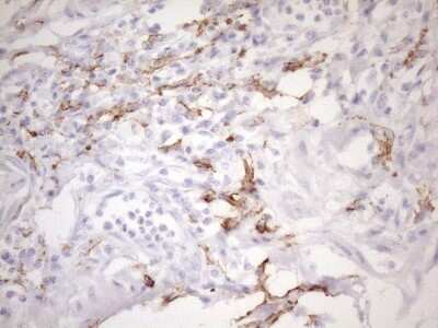 Immunohistochemistry: FOLR2 Antibody (4G6) [NBP2-45693] - Analysis of Adenocarcinoma of Human colon tissue. (Heat-induced epitope retrieval by 1mM EDTA in 10mM Tris buffer (pH8.5) at 120C for 3 min)