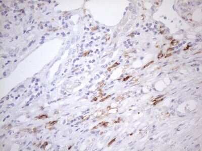 Immunohistochemistry: FOLR2 Antibody (4G6) [NBP2-45693] - Analysis of Carcinoma of Human liver tissue.(Heat-induced epitope retrieval by 1mM EDTA in 10mM Tris buffer (pH8.5) at 120C for 3 min)