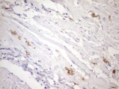 Immunohistochemistry: FOLR2 Antibody (4G6) [NBP2-45693] - Analysis of Carcinoma of Human bladder tissue using FOLR2 mouse monoclonal antibody.(Heat-induced epitope retrieval by 1mM EDTA in 10mM Tris buffer (pH8.5) at 120C for 3 min)