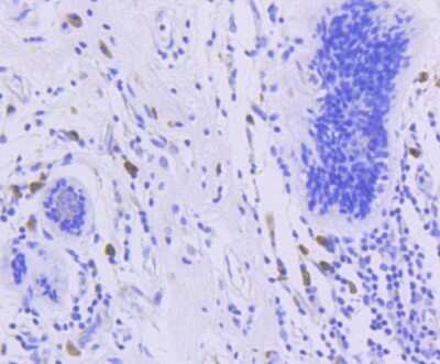 Immunohistochemistry-Paraffin: FOXO3 [p Ser253] Antibody (ST49-01) [NBP2-67521] - Analysis of paraffin-embedded human breast carcinoma tissue using anti-Phospho-FOXO3a(S253) antibody. Counter stained with hematoxylin.