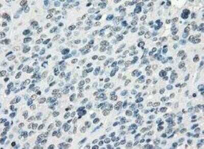 Immunohistochemistry: FRA-1/FOSL1 Antibody (OTI12F9) - Azide and BSA Free [NBP2-71351] - Carcinoma of bladder tissue.