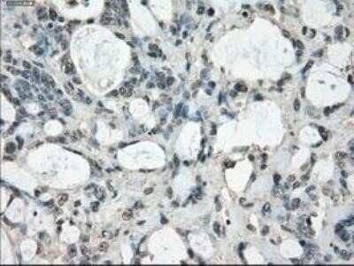 Immunohistochemistry: FRA-1/FOSL1 Antibody (OTI12F9) - Azide and BSA Free [NBP2-71351] - Staining of paraffin-embedded Adenocarcinoma of ovary tissue using anti-FOSL1 mouse monoclonal antibody.