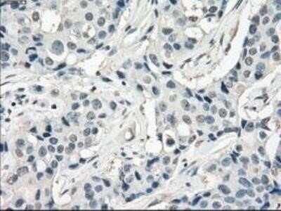 Immunohistochemistry: FRA-1/FOSL1 Antibody (OTI12F9) - Azide and BSA Free [NBP2-71351] - Staining of paraffin-embedded Adenocarcinoma of breast tissue using anti-FOSL1 mouse monoclonal antibody.