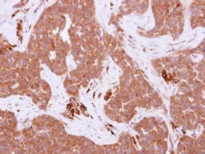 Immunohistochemistry-Paraffin: FRK Antibody [NBP2-16534] - Immunohistochemical analysis of paraffin-embedded AdCA, using antibody at 1:500 dilution.