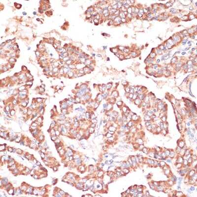 Immunohistochemistry-Paraffin: FRMD6 Antibody [NBP3-05019] -  Human thyroid cancer using FRMD6 antibody at dilution of 1:100 (40x lens).Perform microwave antigen retrieval with 10 mM PBS buffer pH 7.2 before commencing with IHC staining protocol.