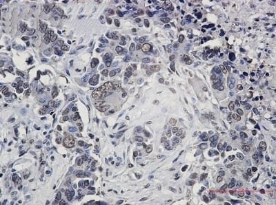 Immunohistochemistry-Paraffin: FUBP1 Antibody (S06-4F3) [NBP3-19639] - Immunohistochemistry of FUBP1 in paraffin-embedded Human Cholangiocarcinoma using NBP3-19639 at dilution 1/20