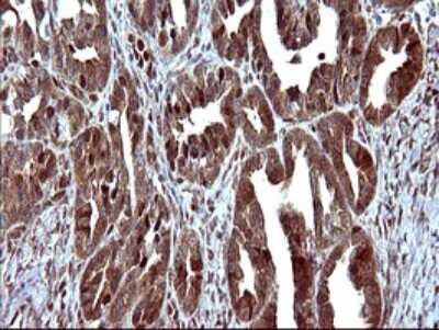 Immunohistochemistry: FUR1 Antibody (2D1) [NBP2-46297] - Analysis of Adenocarcinoma of Human ovary tissue. (Heat-induced epitope retrieval by 10mM citric buffer, pH6.0, 120C for 3min)