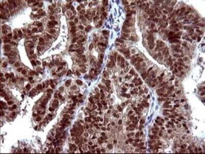 Immunohistochemistry: FUR1 Antibody (2D1) [NBP2-46297] - Analysis of Adenocarcinoma of Human endometrium tissue. (Heat-induced epitope retrieval by 10mM citric buffer, pH6.0, 120C for 3min)