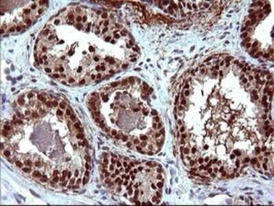 Immunohistochemistry: FUR1 Antibody (2D1) [NBP2-46297] - Analysis of Carcinoma of Human prostate tissue. (Heat-induced epitope retrieval by 10mM citric buffer, pH6.0, 120C for 3min)