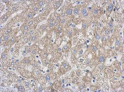 Immunohistochemistry-Paraffin: FUR1 Antibody [NBP2-16547] - Immunohistochemical analysis of paraffin-embedded Hepatoma, using antibody at 1:500 dilution.