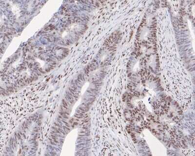 Immunohistochemistry-Paraffin: FUS Antibody (JJ09-31) [NBP2-67913] - Immunohistochemical analysis of paraffin-embedded human colon carcinoma tissue using anti-FUS/TLS antibody. The section was pre-treated using heat mediated antigen retrieval with sodium citrate buffer (pH 6.0) for 20 minutes. The tissues were blocked in 5% BSA for 30 minutes at room temperature, washed with ddH2O and PBS, and then probed with the primary antibody (1/50)  for 30 minutes at room temperature. The detection was performed using an HRP conjugated compact polymer system. DAB was used as the chromogen. Tissues were counterstained with hematoxylin and mounted with DPX.