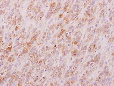 Immunohistochemistry-Paraffin: FUS2 Antibody [NBP2-16548] - Immunohistochemical analysis of paraffin-embedded PC9 xenograft, using antibody at 1:100 dilution.