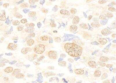 Immunohistochemistry-Paraffin: FUSIP1 Antibody [NB110-93598] - Detection of human FUSIP1 by immunohistochemistry. Sample: FFPE section of human breast carcinoma. Antibody: Affinity purified rabbit anti-FUSIP1 (NB110-93598) used at a dilution of 1:1,000 (1ug/ml). Detection: DAB