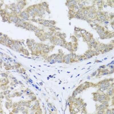 Immunohistochemistry-Paraffin: FXC1 Antibody [NBP3-03225] - Paraffin-embedded human liver cancer using FxC1 antibody at dilution of 1:100 (40x lens).