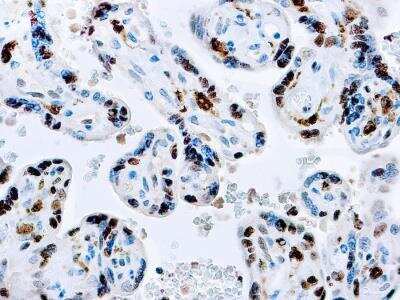 Immunohistochemistry-Paraffin: Factor XIIIa Antibody [NB600-1202] - Formalin fixed paraffin embedded human placenta stained with Factor XIIIa antibody (NB600-1202).