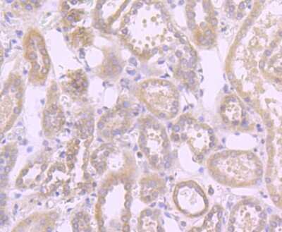 Immunohistochemistry-Paraffin: Fas Receptor/TNFRSF6/CD95 Antibody (JJ0942) [NBP2-66831] - Fas/TNFRSF6/CD95 Antibody (JJ0942) [NBP2-66831] - Analysis of paraffin-embedded human liver cancer tissue using anti-Fas antibody. Counter stained with hematoxylin.