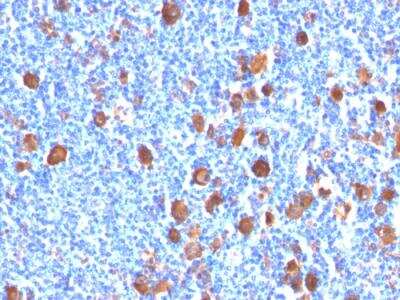 Immunohistochemistry-Paraffin: Fascin Antibody (FSCN1/416) - IHC-Prediluted [NBP2-48310] - Formalin-fixed, paraffin-embedded human Hodgkin's Lymphoma stained with Fascin-1 Mouse Monoclonal Antibody (FSCN1/416).