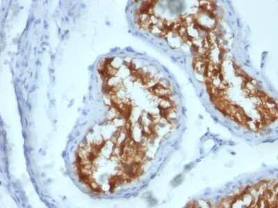 Immunohistochemistry-Paraffin: Fascin Antibody (FSCN1/417) - Azide and BSA Free [NBP2-47801] - Human Testicular Carcinoma stained with Fascin-1 Monoclonal Antibody (FSCN1/417)