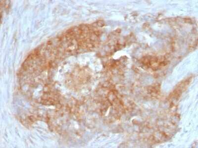 Immunohistochemistry-Paraffin: Fascin Antibody (FSCN1/417) - Azide and BSA Free [NBP2-47801] - Human Ovarian Carcinoma stained with Fascin-1 Monoclonal Antibody (FSCN1/417)