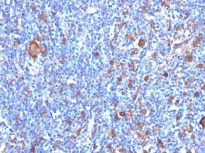 Immunohistochemistry-Paraffin: Fascin Antibody (FSCN1/417) - Azide and BSA Free [NBP2-47801] - Human Hodgkin's Lymphoma stained with Fascin-1 Monoclonal Antibody (FSCN1/417)