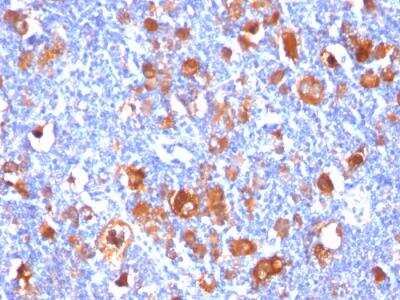 Immunohistochemistry-Paraffin: Fascin Antibody (FSCN1/418) - IHC-Prediluted [NBP2-48337] - Formalin-fixed, paraffin-embedded human Hodgkin's Lymphoma stained with Fascin-1 Mouse Monoclonal Antibody (FSCN1/418).