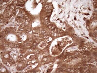 Immunohistochemistry: Fascin Antibody (OTI3B4) - Azide and BSA Free [NBP2-71294] - Analysis of Adenocarcinoma of Human colon tissue. (Heat-induced epitope retrieval by Tris-EDTA, pH8.0)(1:150)