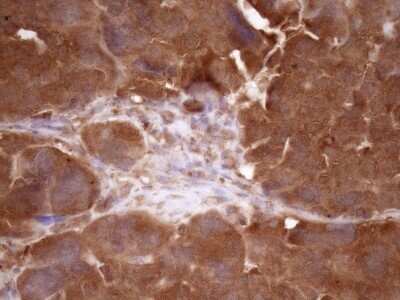 Immunohistochemistry: Fascin Antibody (OTI3B4) - Azide and BSA Free [NBP2-71294] - Analysis of Adenocarcinoma of Human ovary tissue. (Heat-induced epitope retrieval by Tris-EDTA, pH8.0)