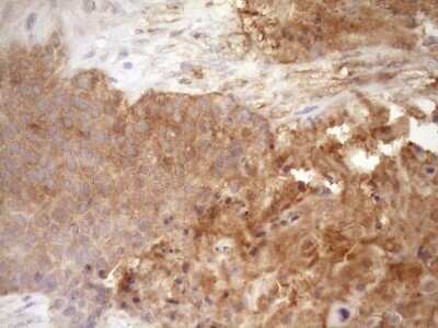 Immunohistochemistry: Fascin Antibody (OTI3B4) - Azide and BSA Free [NBP2-71294] - Analysis of Carcinoma of Human lung tissue.(Heat-induced epitope retrieval by Tris-EDTA, pH8.0)