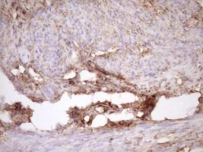 Immunohistochemistry: Fascin Antibody (OTI3B4) - Azide and BSA Free [NBP2-71294] - Analysis of Human thyroid tissue. (Heat-induced epitope retrieval by Tris-EDTA, pH8.0)