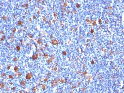 Immunohistochemistry-Paraffin: Fascin Antibody (SPM133) - IHC-Prediluted [NBP2-48312] - Formalin-fixed, paraffin-embedded human Hodgkin's Lymph stained with Fascin-1 Mouse Monoclonal Antibody (SPM133)