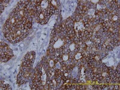 Immunohistochemistry-Paraffin: Fatty Acid Synthase/FASN Antibody (3F2-1F3) [H00002194-M01] - Analysis of monoclonal antibody to FASN on formalin-fixed paraffin-embedded human breast cancer tissue. Antibody concentration 10 ug/ml.