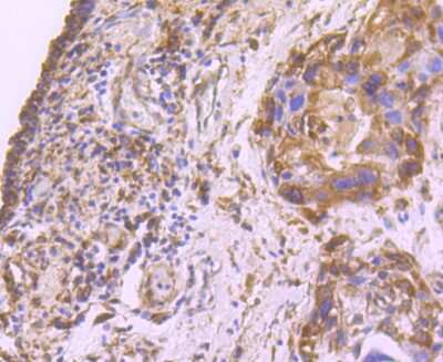 Immunohistochemistry-Paraffin: Fatty Acid Synthase/FASN Antibody (JJ0939) [NBP2-66833] - Analysis of paraffin-embedded human breast carcinoma tissue using anti-Fatty Acid Synthase antibody. Counter stained with hematoxylin.