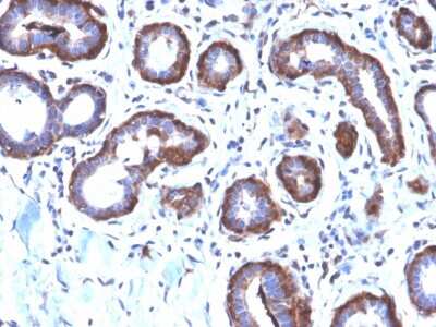 Immunohistochemistry-Paraffin: Ferritin Light Chain Antibody (FTL/2338R) [NBP3-07804] - Formalin-fixed, paraffin-embedded human Breast Carcinoma stained with Ferritin Light Chain Rabbit Recombinant Monoclonal Antibody (FTL/2338R).