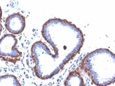 Immunohistochemistry-Paraffin: Ferritin Light Chain Antibody (FTL/3872R) - Azide and BSA Free [NBP3-08623] - Formalin-fixed, paraffin-embedded human breast carcinoma stained with Ferritin Light Chain Recombinant Rabbit Monoclonal Antibody (FTL/3872R).