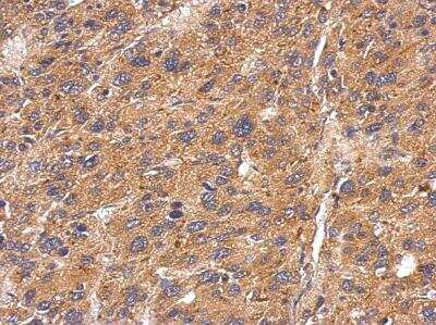 Immunohistochemistry-Paraffin: Fetuin Antibody [NBP2-16470] - Analysis of paraffin-embedded Hepatoma, using antibody at 1:100 dilution.