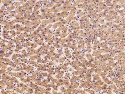 Immunohistochemistry-Paraffin: Fetuin Antibody [NBP2-99415] - Immunochemical staining of human Fetuin in human hepatoma with rabbit polyclonal antibody at 1:300 dilution, formalin-fixed paraffin embedded sections.