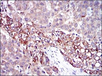 Immunohistochemistry: Fibrinogen gamma chain Antibody (4H9) [NBP2-37556] - Immunohistochemical analysis of paraffin-embedded liver cancer tissues using FGG mouse mAb with DAB staining.