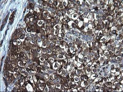 Immunohistochemistry: Fibrinogen gamma chain Antibody (OTI2D2) - Azide and BSA Free [NBP2-70732] - Analysis of Carcinoma of Human liver tissue.(Heat-induced epitope retrieval by 1 mM EDTA in 10mM Tris, pH8.5, 120C for 3min)