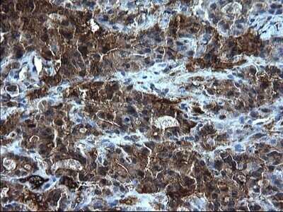 Immunohistochemistry: Fibrinogen gamma chain Antibody (OTI2D2) - Azide and BSA Free [NBP2-70732] - Analysis of Carcinoma of Human thyroid tissue. (Heat-induced epitope retrieval by 1 mM EDTA in 10mM Tris, pH8.5, 120C for 3min)