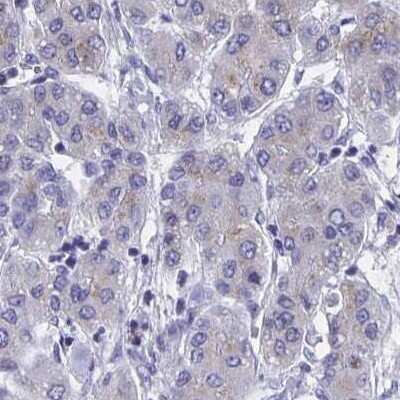 Immunohistochemistry-Paraffin: Fibrinopeptide A Antibody [NBP2-33613] - Staining of liver cancer.