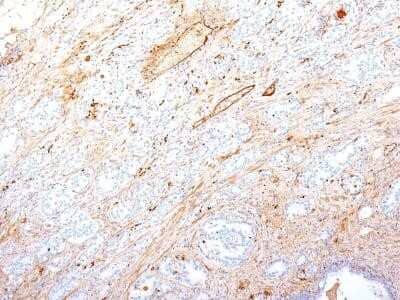 Immunohistochemistry-Paraffin: Fibronectin Antibody (SPM246) - Azide and BSA Free [NBP2-34749] - Formalin-fixed, paraffin-embedded human Pancreatic Adeno Carcinoma stained with Fibronectin Monoclonal Antibody (SPM246).
