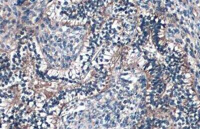 Immunohistochemistry-Paraffin: Fibulin 2 Antibody [NBP1-33479] - Human endometrial carcinoma. Fibulin 2 stained by Fibulin 2 antibody diluted at 1:500.Antigen Retrieval: Citrate buffer, pH 6.0, 15 min.