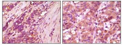 Immunohistochemistry-Paraffin: Fibulin 5/DANCE Antibody (3F10A5) [NBP1-47496] - Analysis of human stomach carcinoma (left) and breast carcinoma (right), showing cytoplasmic localization using fibulin5 mouse mAb with DAB staining.