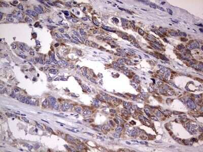 Immunohistochemistry: Filensin Antibody (OTI2B2) - Azide and BSA Free [NBP2-70249] - Analysis of Adenocarcinoma of Human colon tissue.