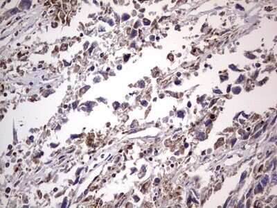 Immunohistochemistry: Filensin Antibody (OTI2B2) - Azide and BSA Free [NBP2-70249] - Analysis of Adenocarcinoma of Human ovary tissue.