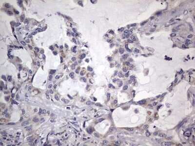 Immunohistochemistry: Filensin Antibody (OTI2B2) - Azide and BSA Free [NBP2-70249] - Analysis of Carcinoma of Human lung tissue.