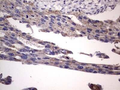 Immunohistochemistry: Filensin Antibody (OTI2B2) - Azide and BSA Free [NBP2-70249] - Analysis of Carcinoma of Human pancreas tissue.