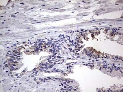 Immunohistochemistry: Filensin Antibody (OTI2B2) - Azide and BSA Free [NBP2-70249] - Analysis of Carcinoma of Human prostate tissue.
