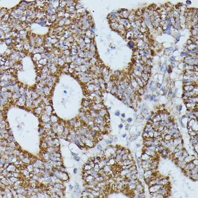 Immunohistochemistry-Paraffin: Flightless I Antibody [NBP3-03712] - Paraffin-embedded human colon carcinoma using Flightless I antibody at dilution of 1:100 (40x lens).