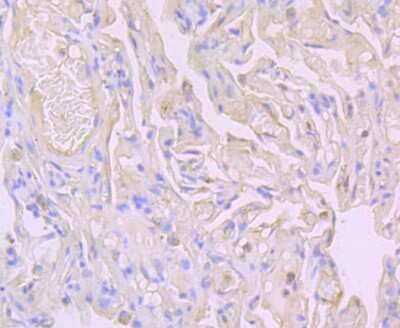 Immunohistochemistry-Paraffin: Flotillin-1 Antibody (JB19-45) [NBP2-75492] - Analysis of paraffin-embedded human lung cancer tissue using anti-Flotillin 1 antibody. Counter stained with hematoxylin.